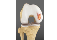 Abrasion Arthroplasty