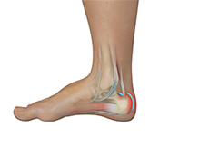 Achilles Tendon Bursitis