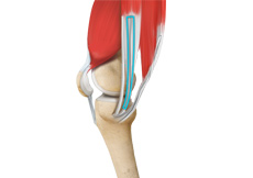 ACL Reconstruction Procedure of Hamstring Tendon
