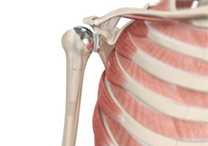 Am I a Candidate for Shoulder Replacement?