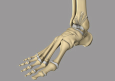 Ankle Arthrodesis