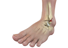 Ankle Fractures