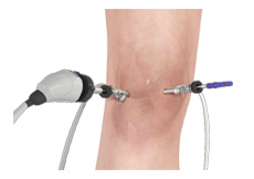 Arthroscopic Reconstruction of the Knee for Ligament Injuries
