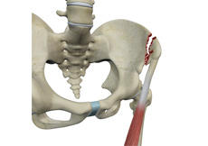 Avulsion Fractures of the Pelvis