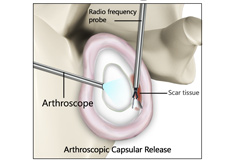 Capsular Release