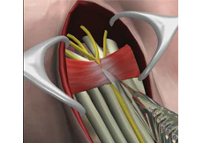 Carpal Tunnel Release Surgery