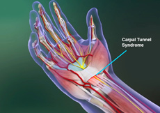 Carpal Tunnel Syndrome