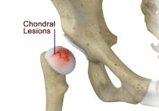 Chondral Lesions or Injuries