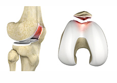 Chondromalacia Patella