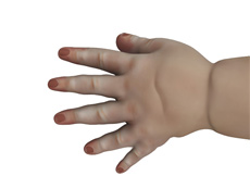 Congenital Defects of the Hand and Wrist