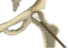 Core Decompression for Avascular Necrosis of the Hip