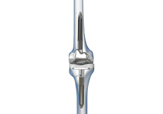 Correction of a Failed Knee Replacement