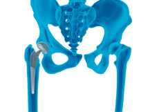 Correction of a Loose Hip Replacement