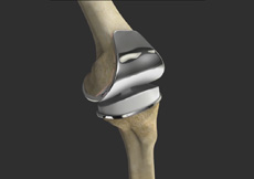 Correction of a Loose Knee Replacement