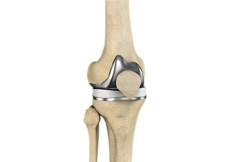 Correction of a Painful Knee Replacement