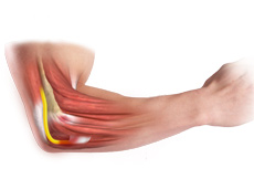 Cubital Tunnel Syndrome (Ulnar Nerve Entrapment)