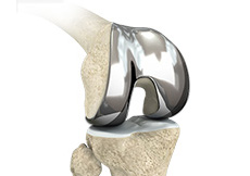 Custom-fitted Total Knee Arthroplasty