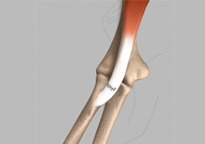 Distal Biceps Repair