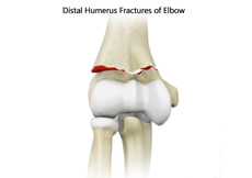 Distal Humerus Fractures of the Elbow