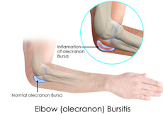 Elbow (Olecranon) Bursitis