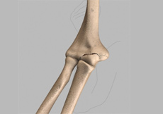 Elbow Fracture Reconstruction