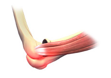 Elbow Sprain