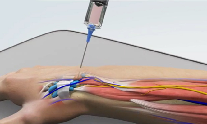 Elective Emergency Hand Surgery