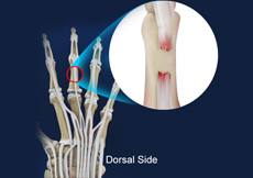 Extensor Tendon Injuries