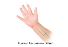 Forearm Fractures in Children