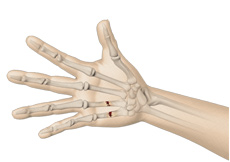 Fractures of the Hand and Fingers