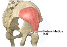 Gluteus Medius Tear