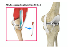 Hamstring Allograft