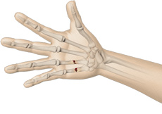 Hand Fracture Surgery
