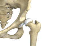 Hip Dislocation