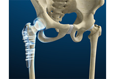 Hip Fracture ORIF