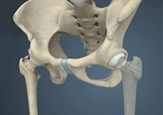 Hip Fracture Surgery