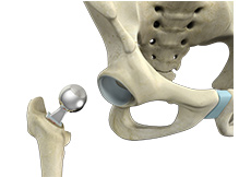  Hip Hemiarthroplasty