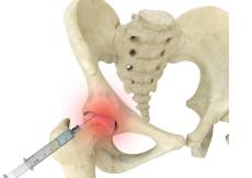 Hip Injections