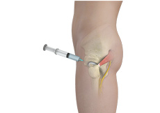 Hip Steroid Injection