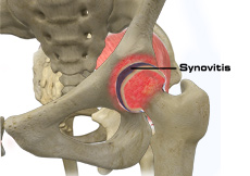 Hip Synovitis