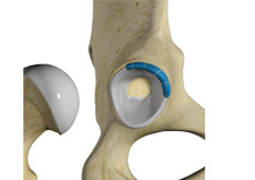 Hip Trauma Reconstruction