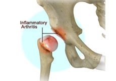 Inflammatory Arthritis of the Hip