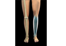  Internal and External Fixation of Foot and Ankle Fractures