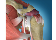 Internal Impingement of the Shoulder