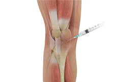 Knee Steroid Injection