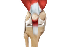 Kneecap Bursitis