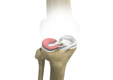 Lateral Meniscus Syndrome