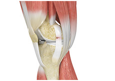 Ligament Injuries