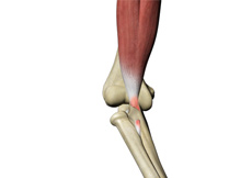 Long Head Biceps Tendon Rupture