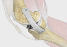 MCL Reconstruction